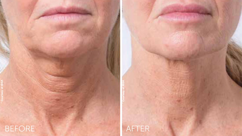Profhilo before & after neck treatment