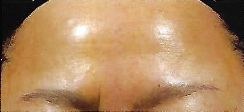 After Retinol Peel Treatment