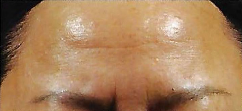 Before Retinol Peel Treatment