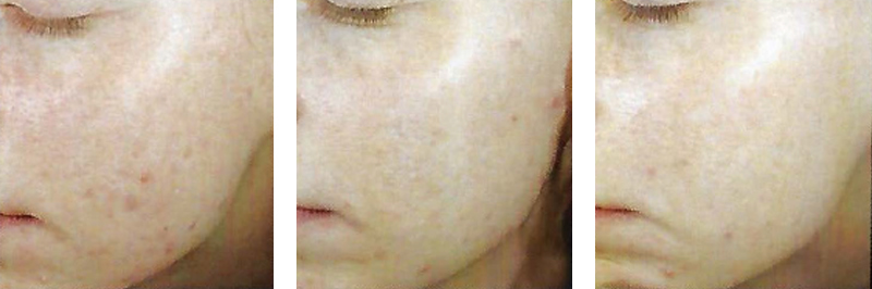 Retinol Peel for Acne Scarring