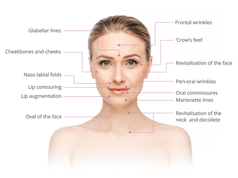 Which areas can be treated with Fillers?
