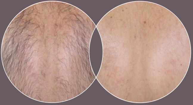 Laser hair removal Bracknell, Berkshire at Crownwood clinic