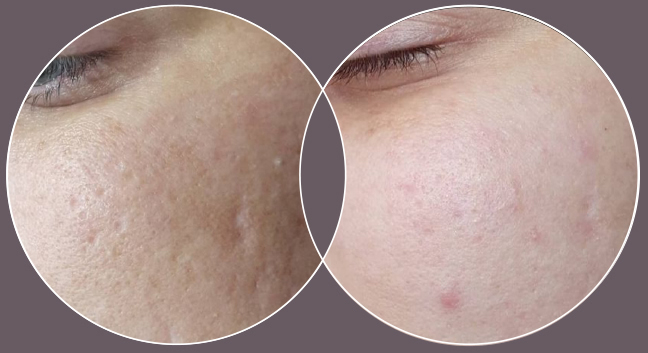 Microneedling near me