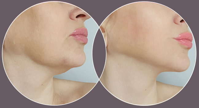 NIR Skin Tightening treatment at CrownWood MediSpa