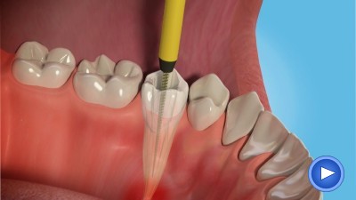 root canal treatment near me explained