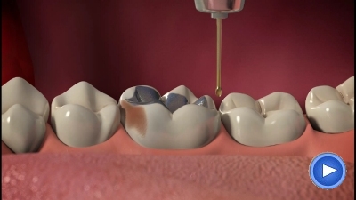 WebPakOnline Dental Crowns