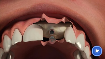WebPakOnline Dental Implants