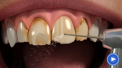 WebPakOnline Porcelain Veneers