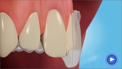 Teeth Whitening in Berkshire