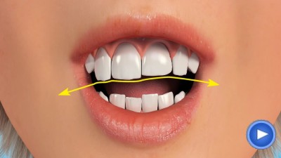 WebPakOnline Teeth Reshaping