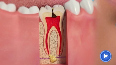 WebPakOnline Decay Occlusal