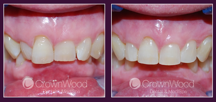Orthodontics at CrownWood Dental Bracknell