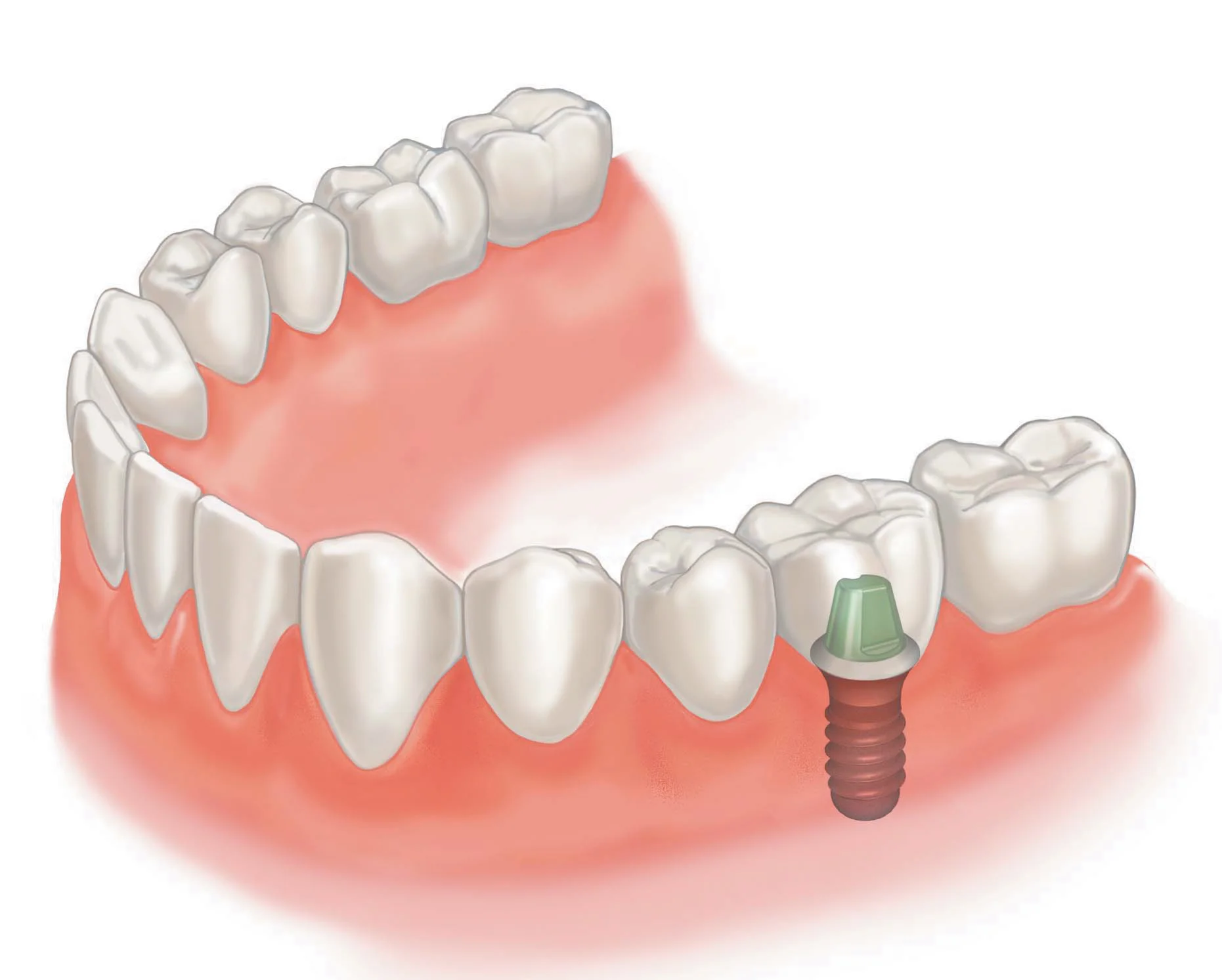 Spaced teeth