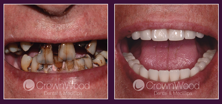 Teeth in a Day Implants at CrownWood MediSpa Bracknell