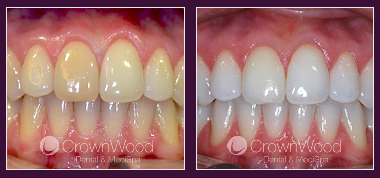 Teeth whitening at CrownWood Dental Bracknell
