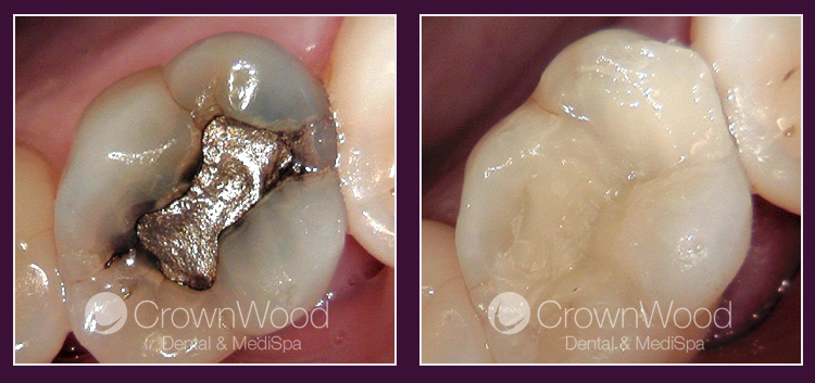 White fillings at CrownWood Dental Bracknell