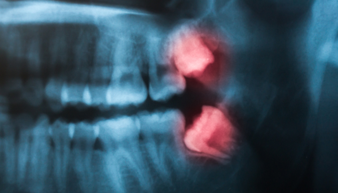 Wisdom tooth removal at CrownWood Dental Bracknell