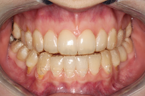 Jennas Invisalign Journey Month 1