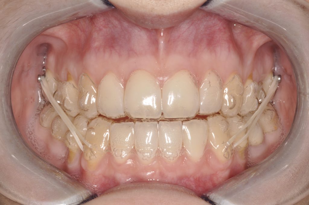 Jenna s Invisalign Journey Month 2 CrownWood Dental jenna-s-invisalign-journey-month-2-crownwood-dental