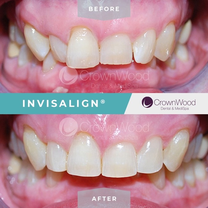 A fantastic Invisalign Invisible braces before and after. ?